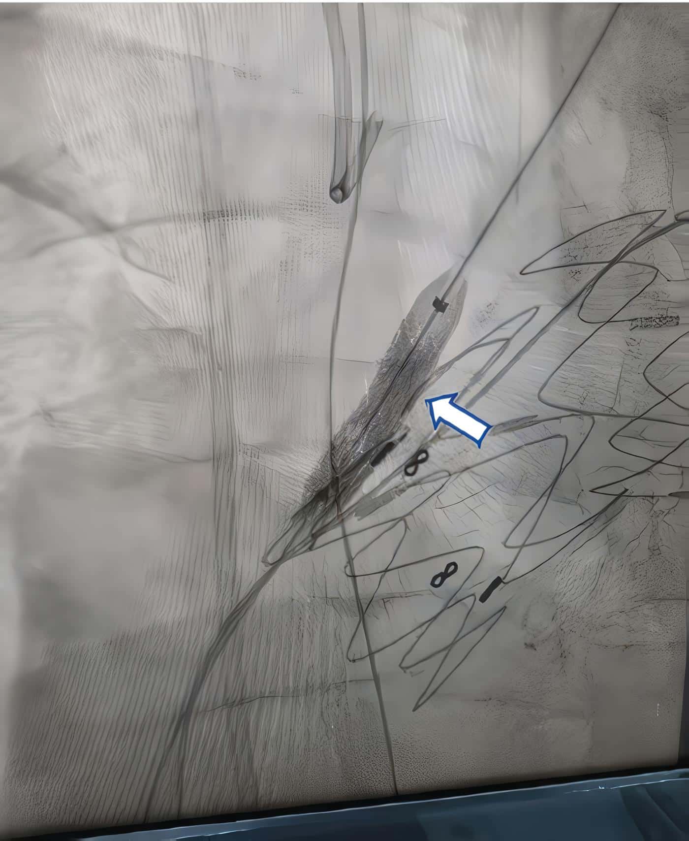 Prótesis Advanta - Tratamiento Endovascular 