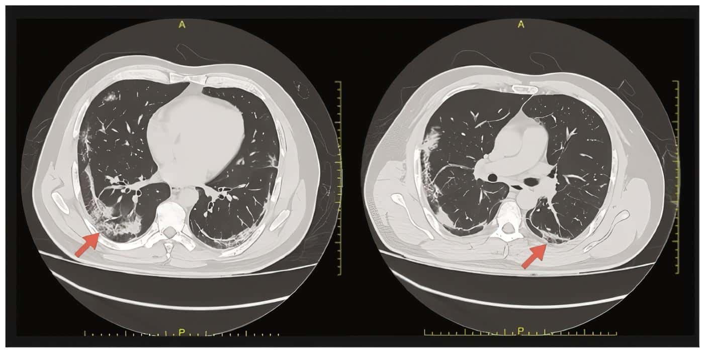 High-resolution chest computed tomography High-resolution chest computed tomography