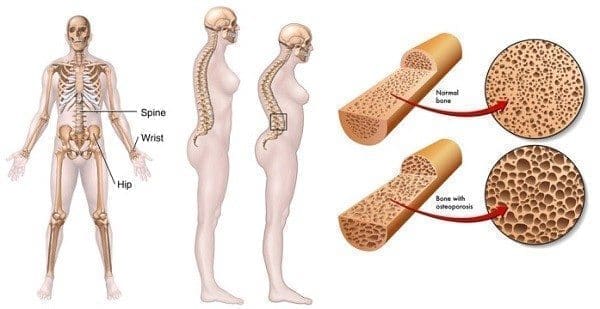 Hiperprolactinemia, Anovulacion y Osteoporosis