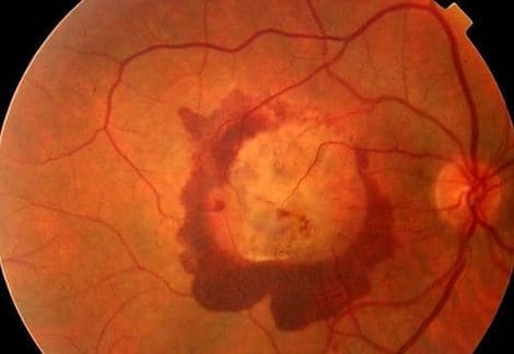 Degeneración Macular “Seca”