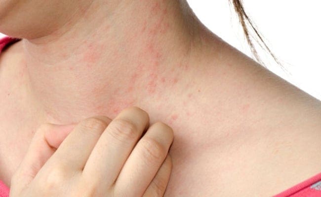 Remedios caseros para la urticaria