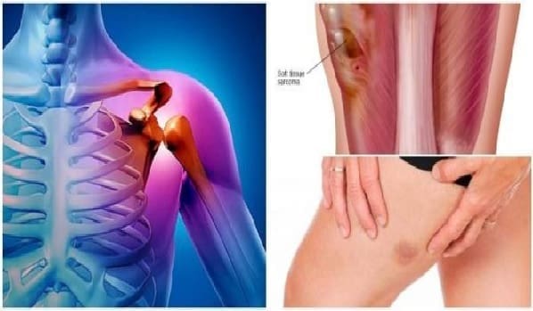 Sarcomas, Evolución en el Diagnóstico