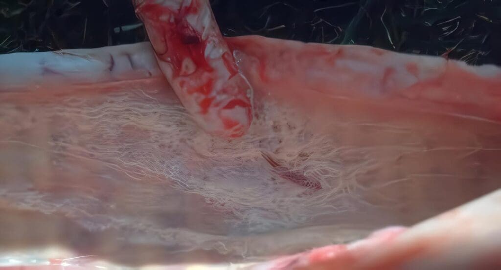 Diagnóstico de Giardiasis y Sobrecrecimiento Bacteriano