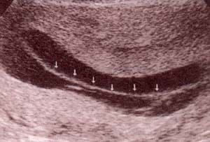 Diagnóstico Prenatal - membrana interamniótica.