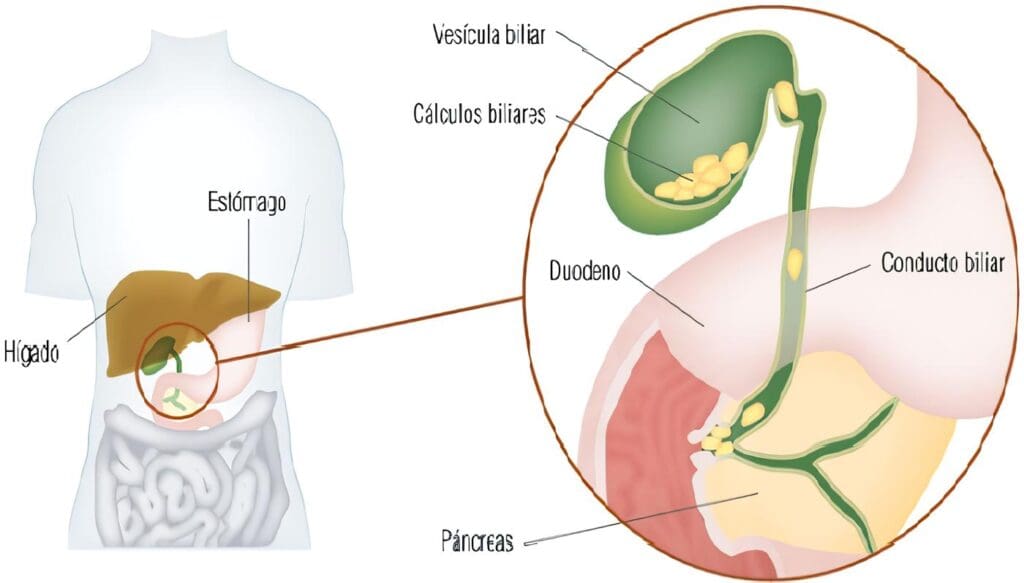 Controversias en el Manejo de la Colecistitis Aguda Tardía