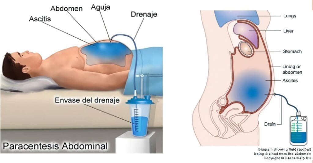 Mortalidad y Morbilidad de la Peritonitis Secundaria con Relaparotomía Planeada