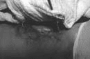 cruenta en el tercio medio anterior de la pierna.