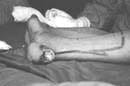 Incisiones para obtener colgajo fasciosubcutáneos