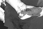 Colgajo plantar medial contralateral, Cirugía Plástica