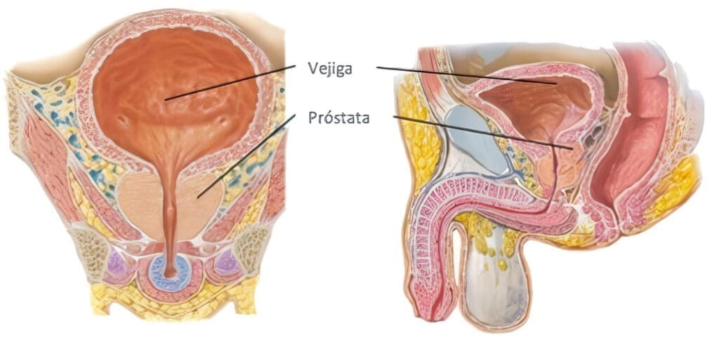 Desarrollo de Métodos Quirúrgicos y Para-Quirúrgicos, Hiperplasia Prostática Benigna