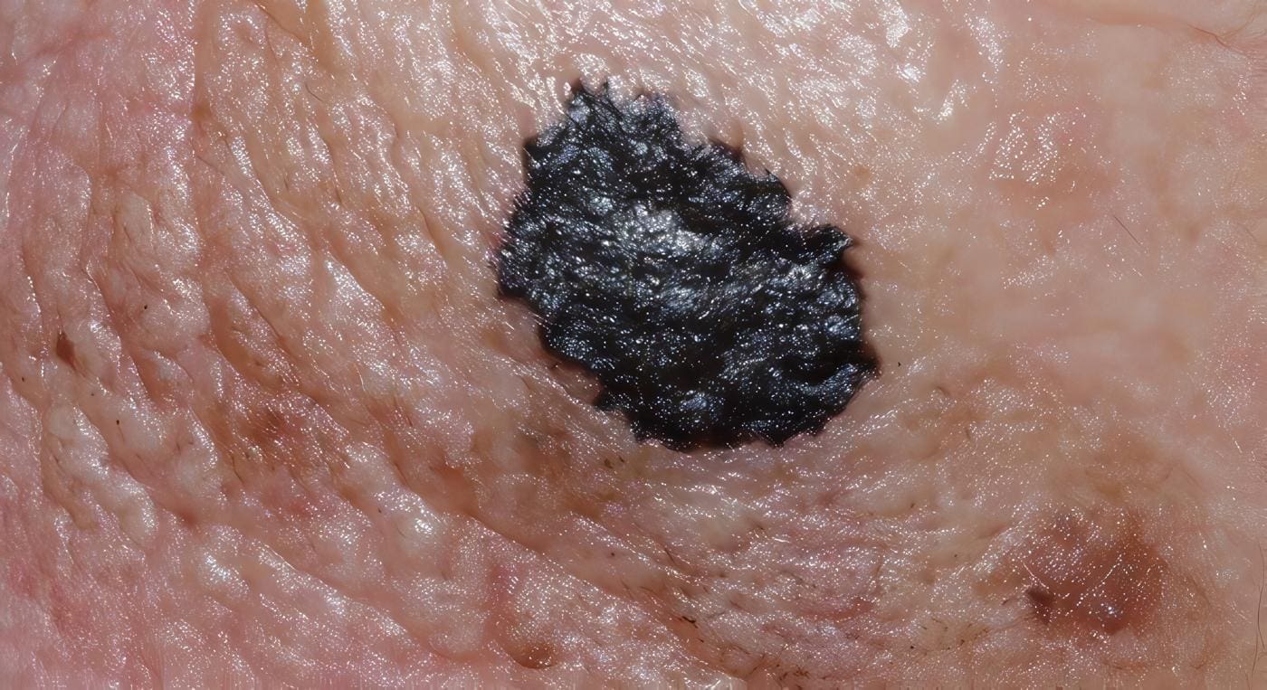 Melanoma Maligno