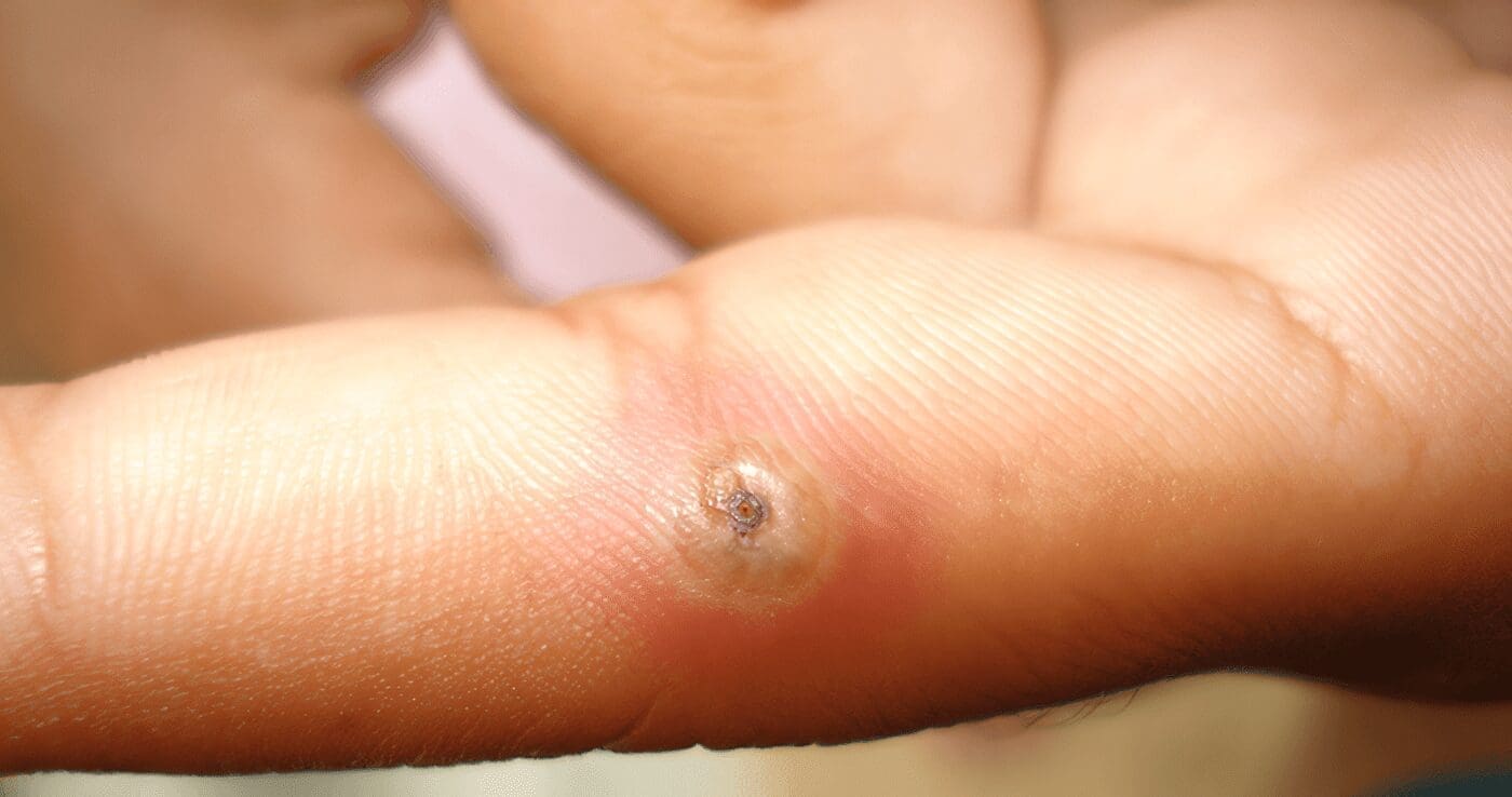 tungiasis