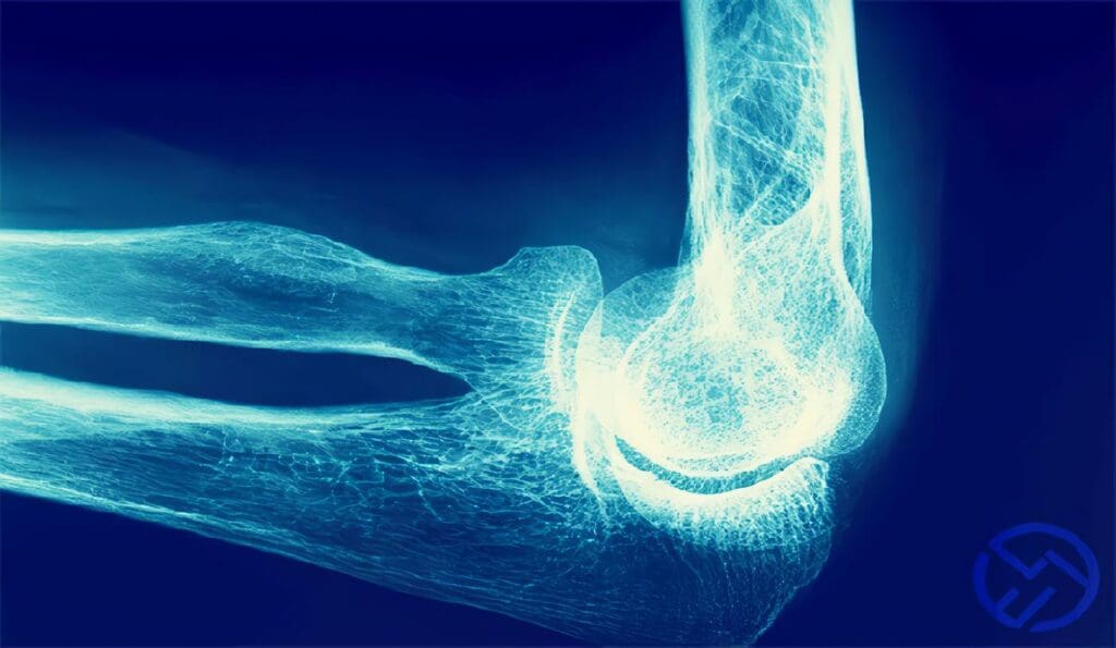 Prevención de la Osteoporosis