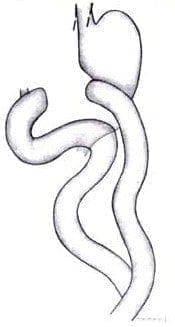 Gastro yeyunostomía en Y de Roux