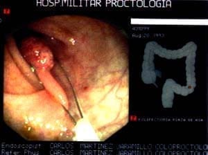Asa de polipectomía, Pólipo Colorrectal Maligno