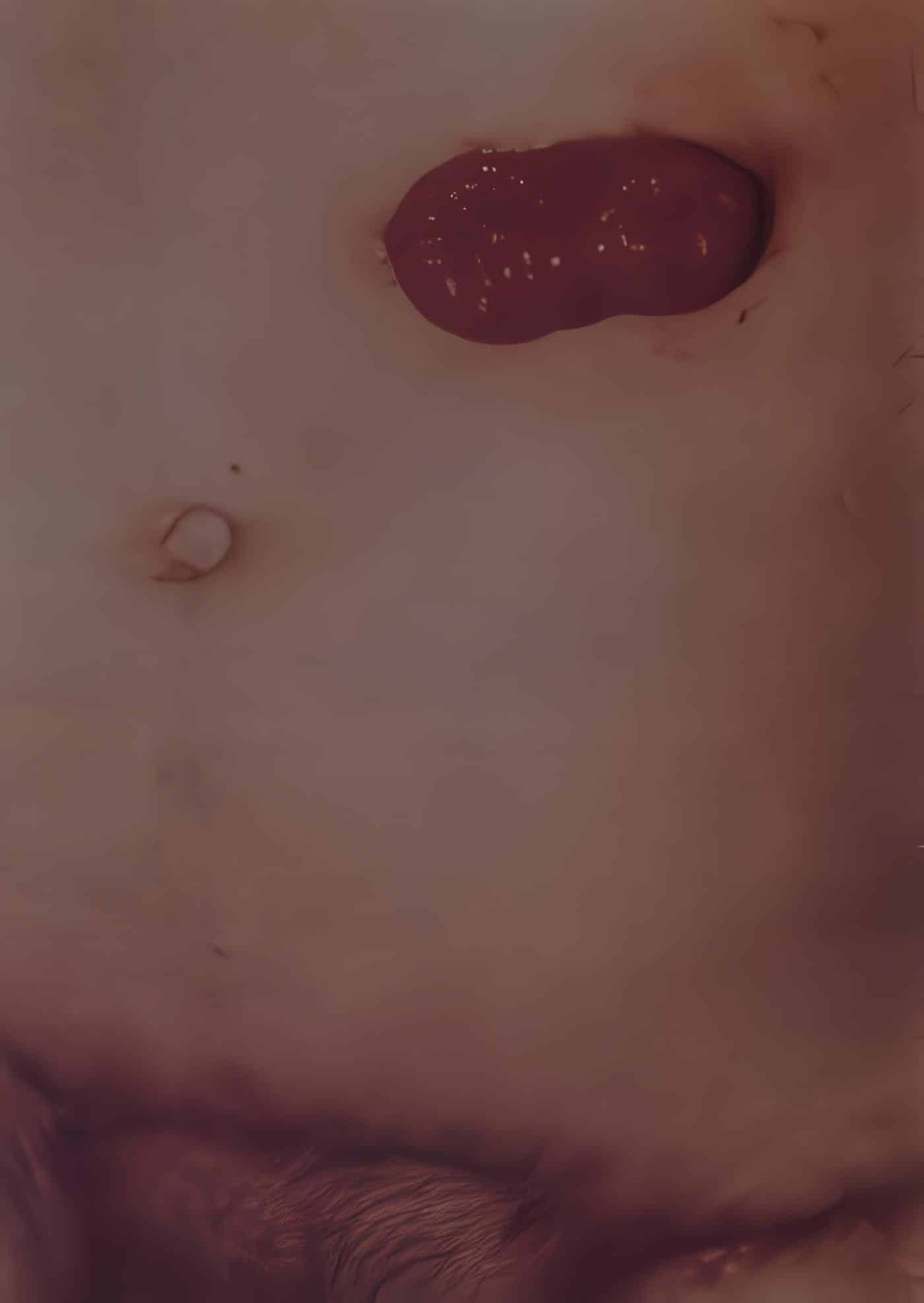 Colostomía Colostomía