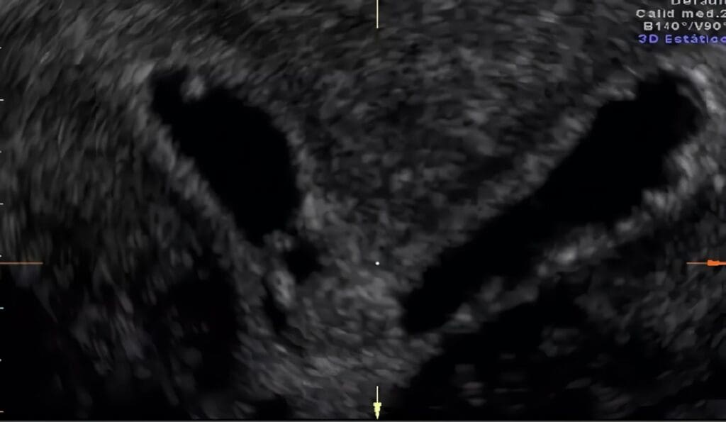 Terapia Hormonal y Hemostasis