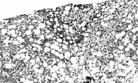Esteatohepatitis no Alcohólica en la Infancia