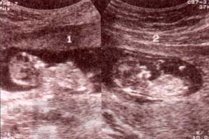 Diagnóstico Prenatal -  .gemelar monocorial - monoamniótico