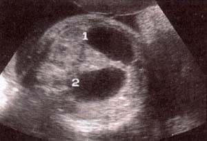 Atresia duodenal