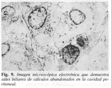 Sales biliares de cálculos abandonados en la cavidad peritoneal