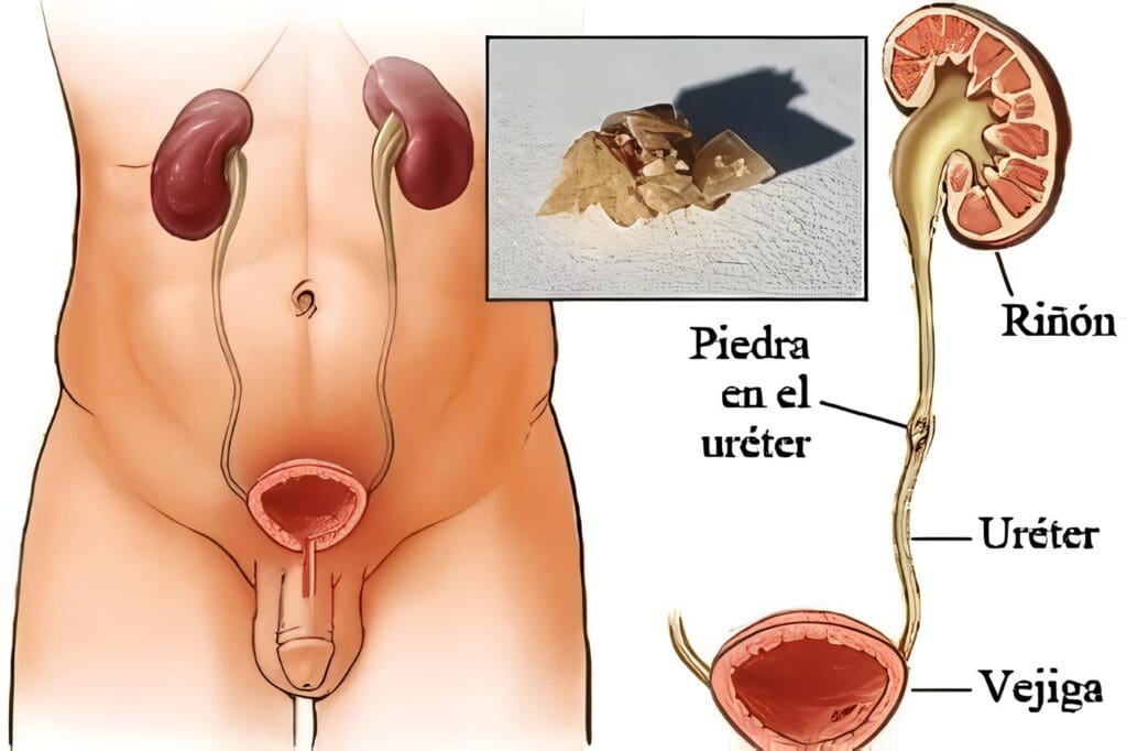 Ureterolitotomia Endoscopica Experiencia en 300 Casos
