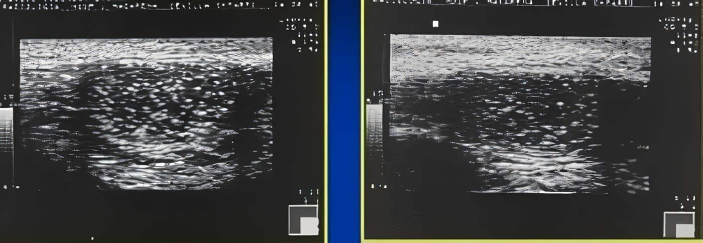 vu101-Microlitiasis Testicular