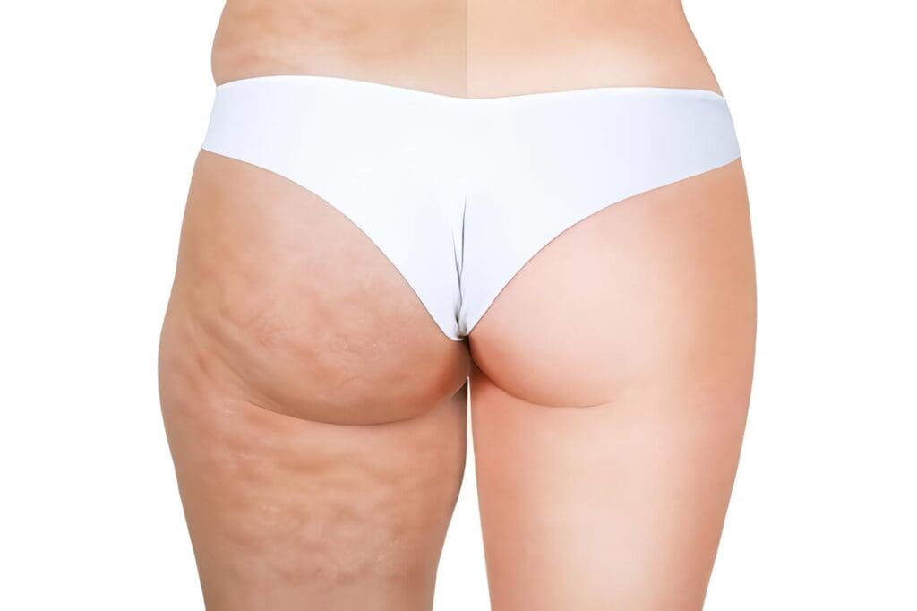 Clases de Celulitis