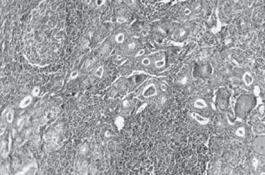  Cuadro de paciente con tiroiditis crónica de Hashimoto