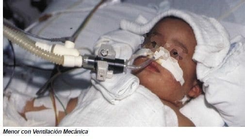 Ventilación Líquida en Falla Respiratoria Hipoxémica en Infantes