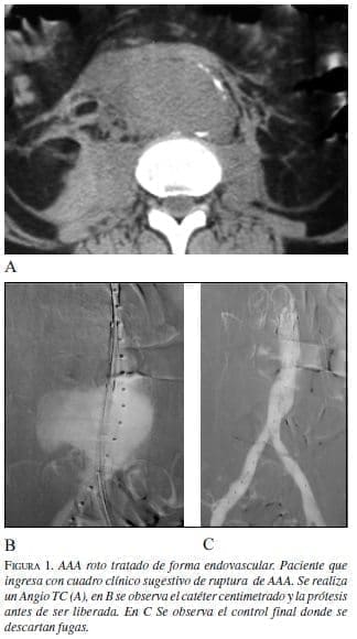 AAA Roto Tratado de forma Endovascular