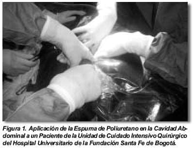 Aplicación de la Espuma de Poliuretano en la Cavidad Abdominal Aplicación de la Espuma de Poliuretano en la Cavidad Abdominal