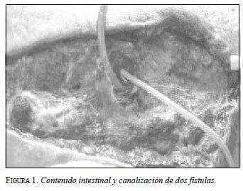 Contenido Intestinal y Canalización de dos Fístulas