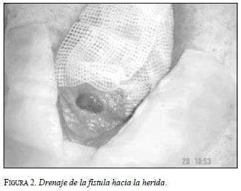 Drenaje de la Fístula hacia la Herida