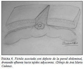 Fístula Asociada con Defecto de la Pared Abdominal