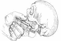 Palpación intraoral de la fosa amigdalina