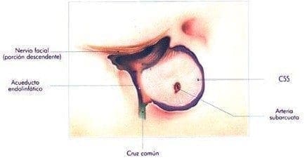 Laberintectomía