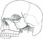 Tipos de fractura de tercio medio facial