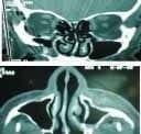 Fractura malar en corte axial y coronal