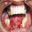 Fractura mandibular abierta