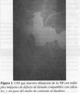 CIO que muestra dilatación de la VB