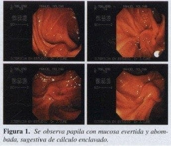 Papila con Mucosa Evertida y Abombada