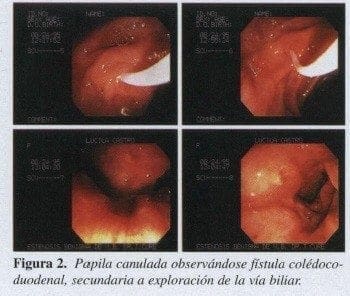 Papila Canulada observándose Fístula Colédocoduodenal