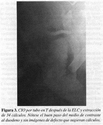 CIO por tubo en T después de la ELC
