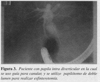 Paciente con Papila Intra Diverticular