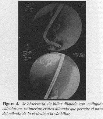 Vía Biliar Dilatada con múltiples cálculos en su interior