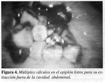 Múltiples cálculos en el Epiplón Listos