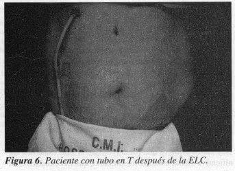 Paciente con tubo en T después de la ELC