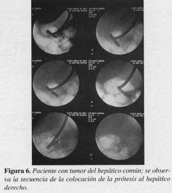 Paciente con Tumor del Hepático común