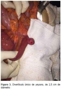 Divertículo Único de Yeyuno, de 2,5 cm de diámetro